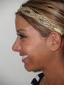 Revision Rhinoplasty