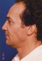 Revision Rhinoplasty
