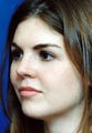 Revision Rhinoplasty