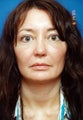 Revision Rhinoplasty