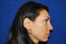 Revision Rhinoplasty