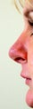 Revision Rhinoplasty
