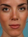 Revision Rhinoplasty