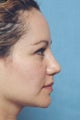 Revision Rhinoplasty