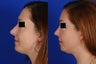 Revision Rhinoplasty