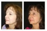 Rhinoplasty Revision