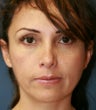 Revision tip rhinoplasty