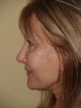Revision Rhinoplasty