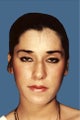 Rhinoplasty
