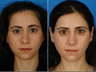 Nose Surgery (Revision Rhinoplasty)