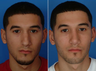 Nose Surgery (Revision Rhinoplasty)