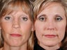 Revision rhinoplasty