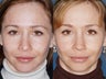 Revision rhinoplasty