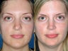 Revision rhinoplasty