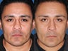 Revision rhinoplasty