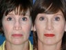 Revision rhinoplasty