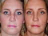 Revision rhinoplasty