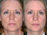 Revision rhinoplasty