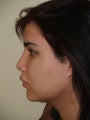 Revision Rhinoplasty