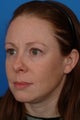 Rhinoplasty