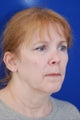 Facelift and Revision Rhinoplasty