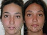 Rhinoplasty (Nose Job)