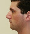 Rhinoplasty revision