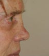 Revision rhinoplasty