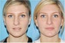 Rhinoplasty