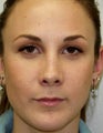 Revision Rhinoplasty