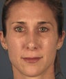 Revision Rhinoplasty