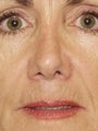 Revision Rhinoplasty