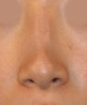Revision Rhinoplasty
