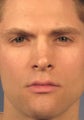 Revision Rhinoplasty