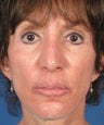 Revision Rhinoplasty