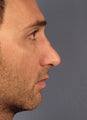 Revision Rhinoplasty