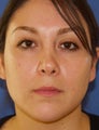 Revision Rhinoplasty