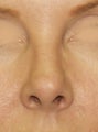 Revision Rhinoplasty