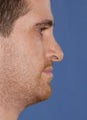 Revision Rhinoplasty