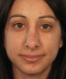 Revision Rhinoplasty