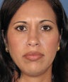 Revision Rhinoplasty
