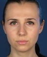 Revision Rhinoplasty