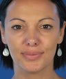 Revision Rhinoplasty