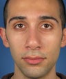 Revision Rhinoplasty