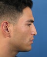 Revision Rhinoplasty