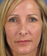 Revision Rhinoplasty