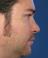 Revision Rhinoplasty