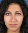 Revision Rhinoplasty