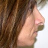 Revision Rhinoplasty