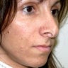 Revision Rhinoplasty